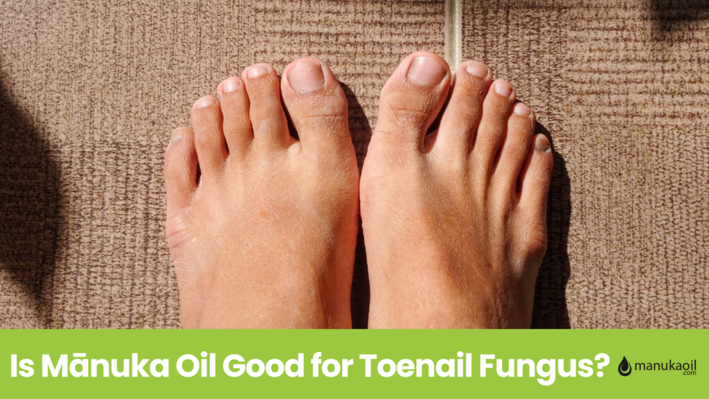 feet showing toes on carpet feet showing toee on carpet Is Mānuka Oil Good for Toenail Fungus? www.manukaoil.com