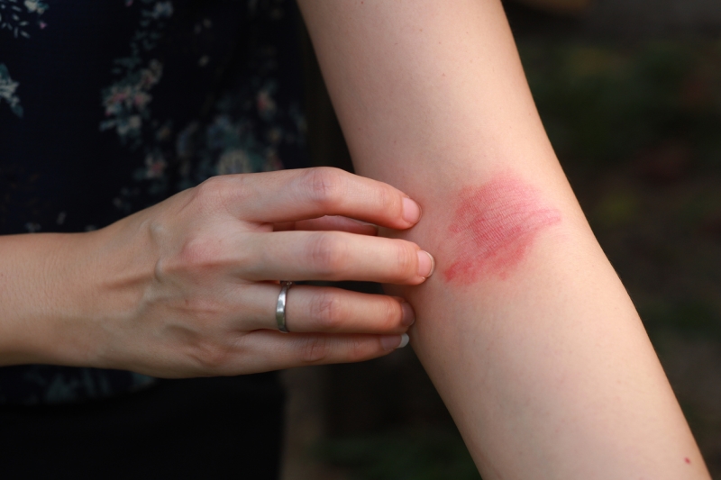 Eczema allergy skin, atopic dermatitis www.manukaoil.com