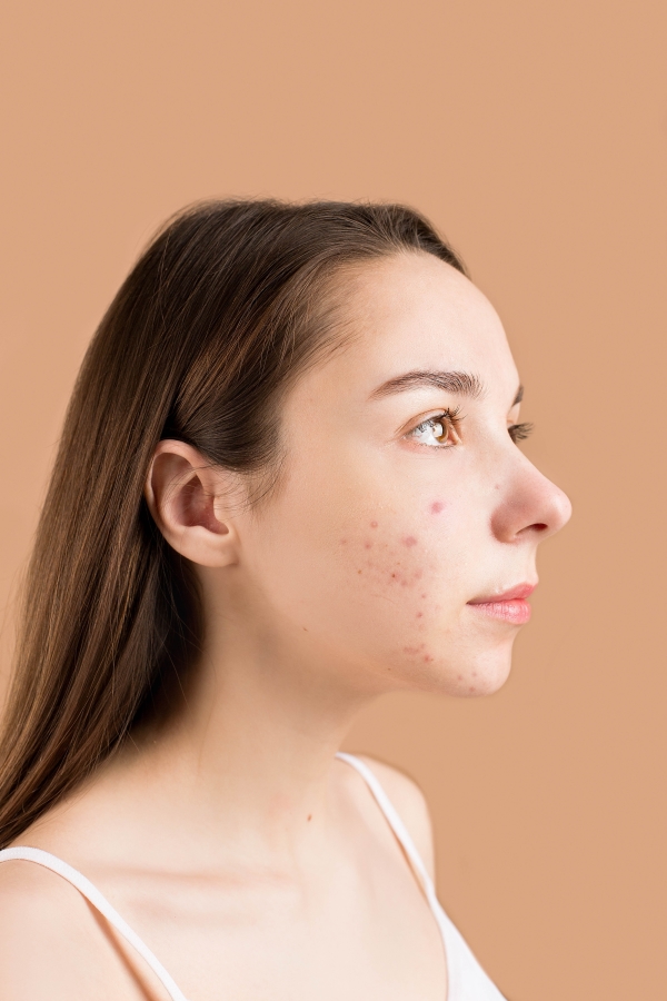 Close-Up Photo of a Teenager with Acne on Her Face
