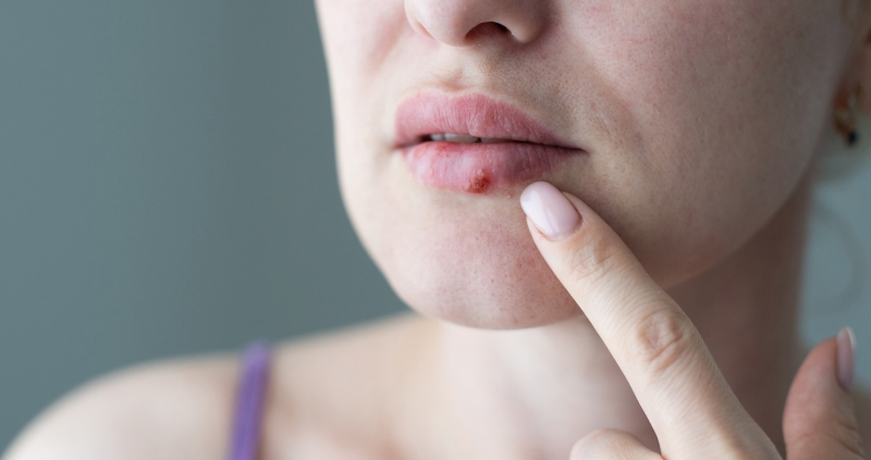 woman with a virus herpes cold sores on lips Does Mānuka Oil Help Cold Sores? www.manukaoil.com