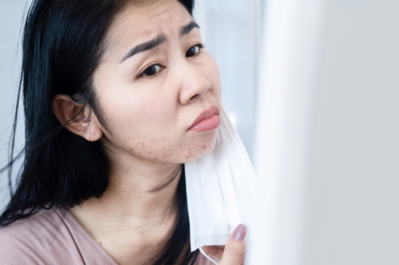 Asian woman having acne and rash skin allergy under chin and face because of protective mask stock photo Does Manuka Oil Help Acne? www.manukaoil.com